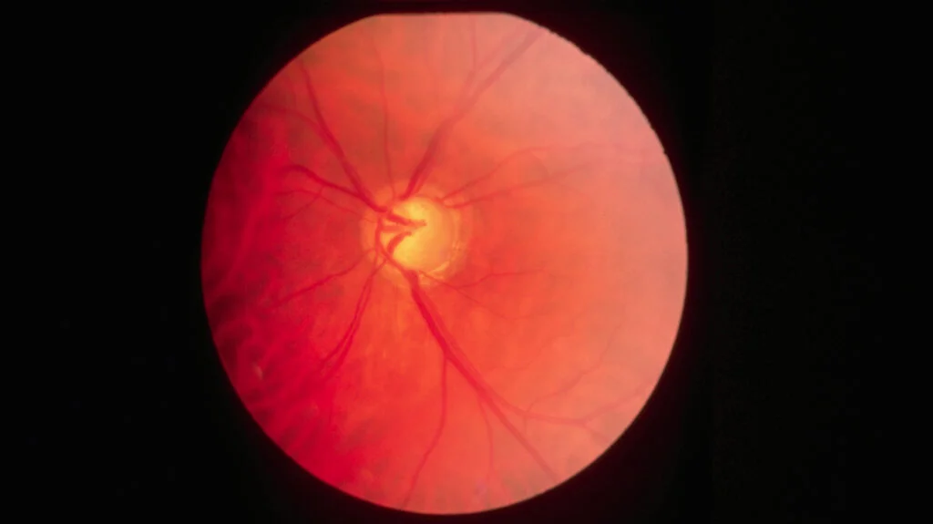Glaucoma